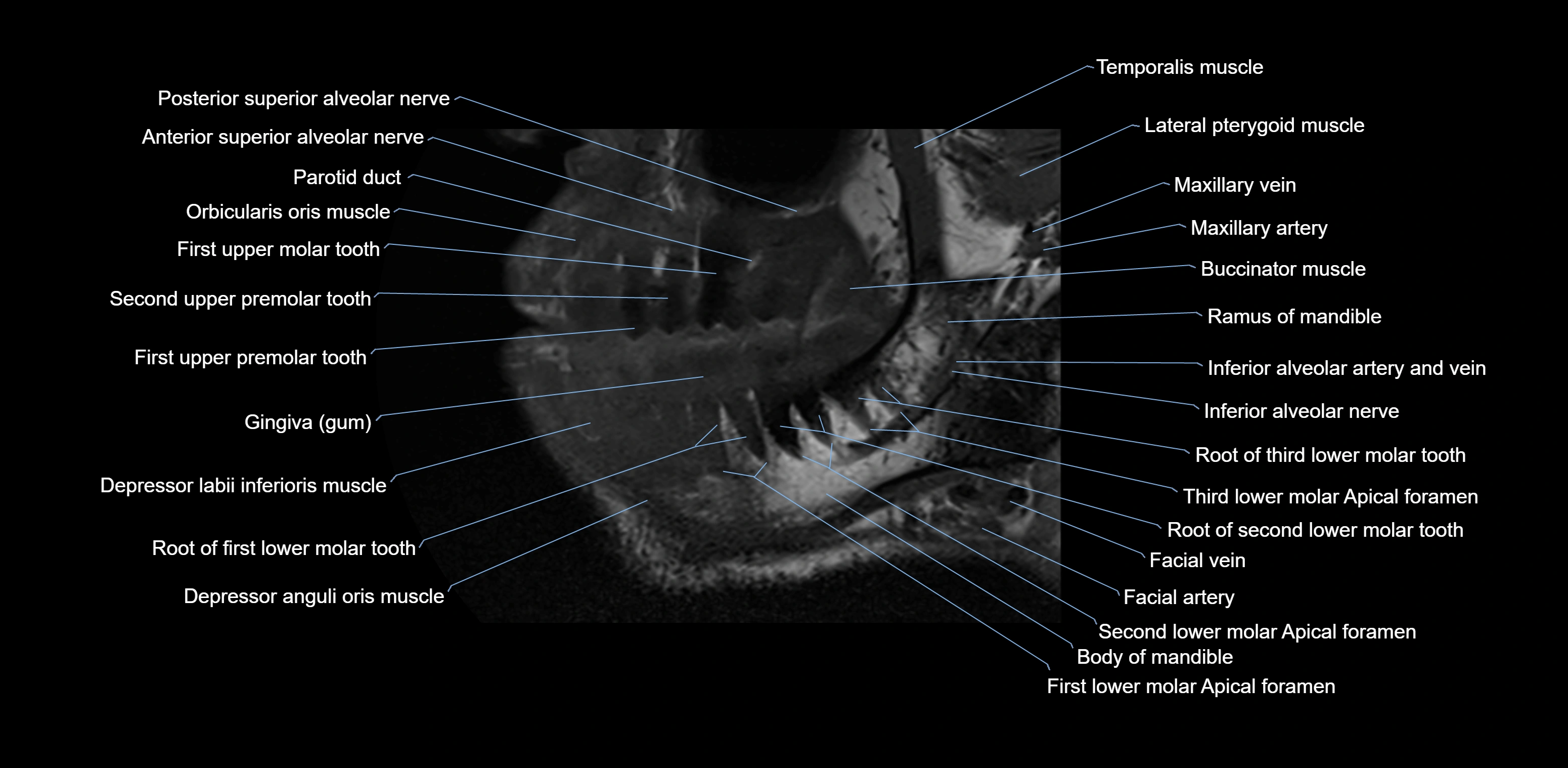 Dental MRI( tooth) sagittal labelled  cross sectional 3T anatomy -img-00001-00004.webp